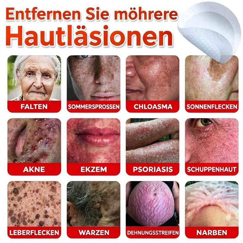 🌈ODALIT™ Pflaster zur pflanzlichen Entfernung von Stielwarzen mit Mikronadeln