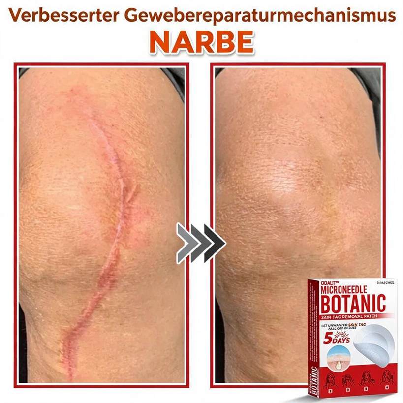 🌈ODALIT™ Pflaster zur pflanzlichen Entfernung von Stielwarzen mit Mikronadeln