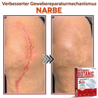 🌈ODALIT™ Pflaster zur pflanzlichen Entfernung von Stielwarzen mit Mikronadeln