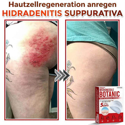 🌈ODALIT™ Pflaster zur pflanzlichen Entfernung von Stielwarzen mit Mikronadeln