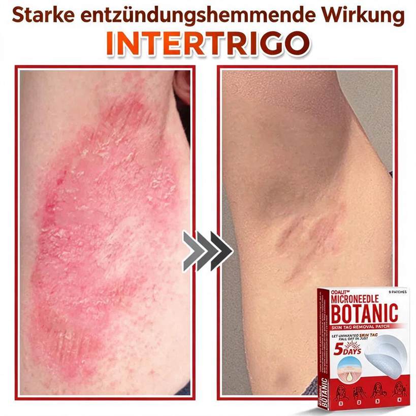 🌈ODALIT™ Pflaster zur pflanzlichen Entfernung von Stielwarzen mit Mikronadeln