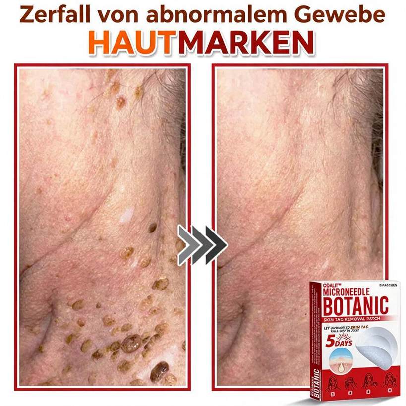 🌈ODALIT™ Pflaster zur pflanzlichen Entfernung von Stielwarzen mit Mikronadeln