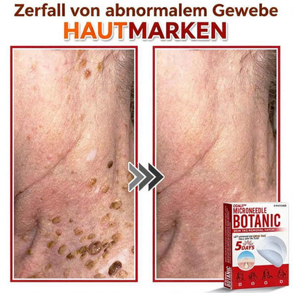 🌈ODALIT™ Pflaster zur pflanzlichen Entfernung von Stielwarzen mit Mikronadeln