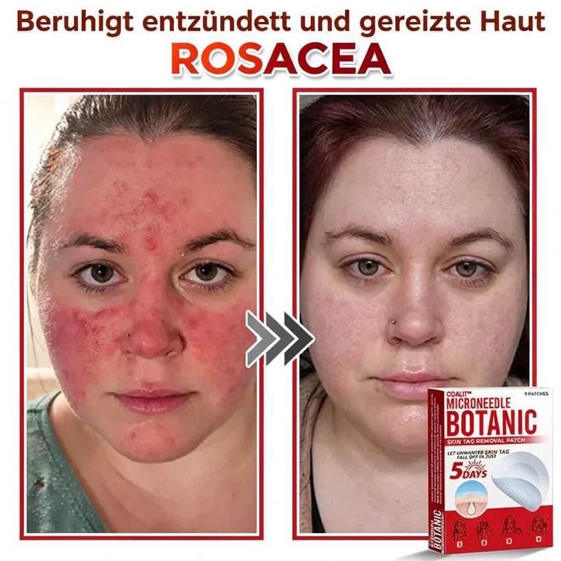 🌈ODALIT™ Pflaster zur pflanzlichen Entfernung von Stielwarzen mit Mikronadeln