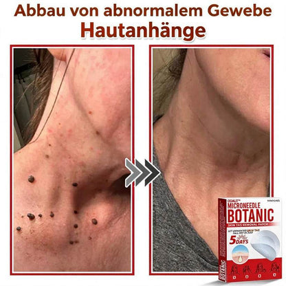 🌈ODALIT™ Pflaster zur pflanzlichen Entfernung von Stielwarzen mit Mikronadeln