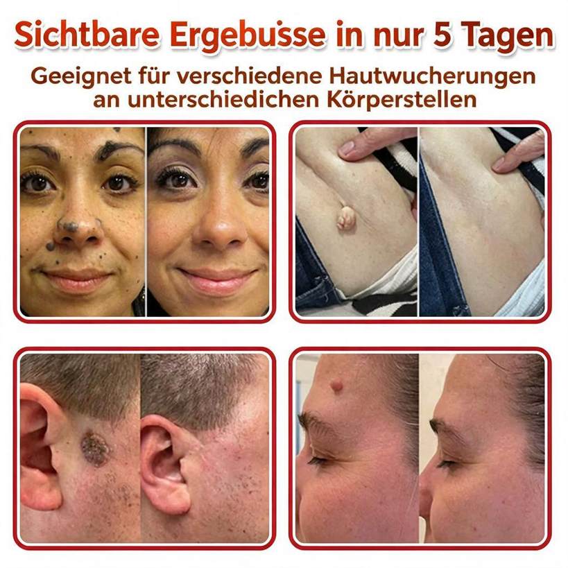 🌈ODALIT™ Pflaster zur pflanzlichen Entfernung von Stielwarzen mit Mikronadeln