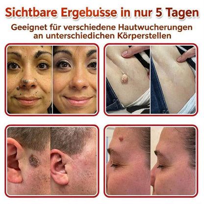 🌈ODALIT™ Pflaster zur pflanzlichen Entfernung von Stielwarzen mit Mikronadeln