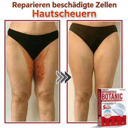 🌈ODALIT™ Pflaster zur pflanzlichen Entfernung von Stielwarzen mit Mikronadeln